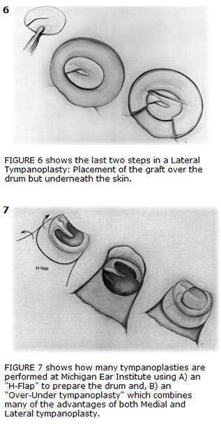 Tympanoplasty (Repairing Ear Drums) - Michigan Ear Institute